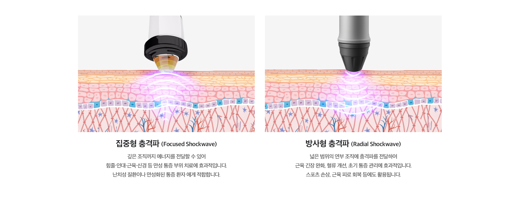 집중형 충격파 (Focused Shockwave) : 깊은 조직까지 에너지를 전달할 수 있어 힘줄·인대·근육·신경 등 만성 통증 부위 치료에 효과적입니다. 난치성 질환이나 만성화된 통증 환자 에게 적합합니다. / 방사형 충격파 (Radial Shockwave) : 넓은 범위의 연부 조직에 충격파를 전달하여 근육 긴장 완화, 혈류 개선, 초기 통증 관리에 효과적입니다. 스포츠 손상, 근육 피로 회복 등에도 활용됩니다.